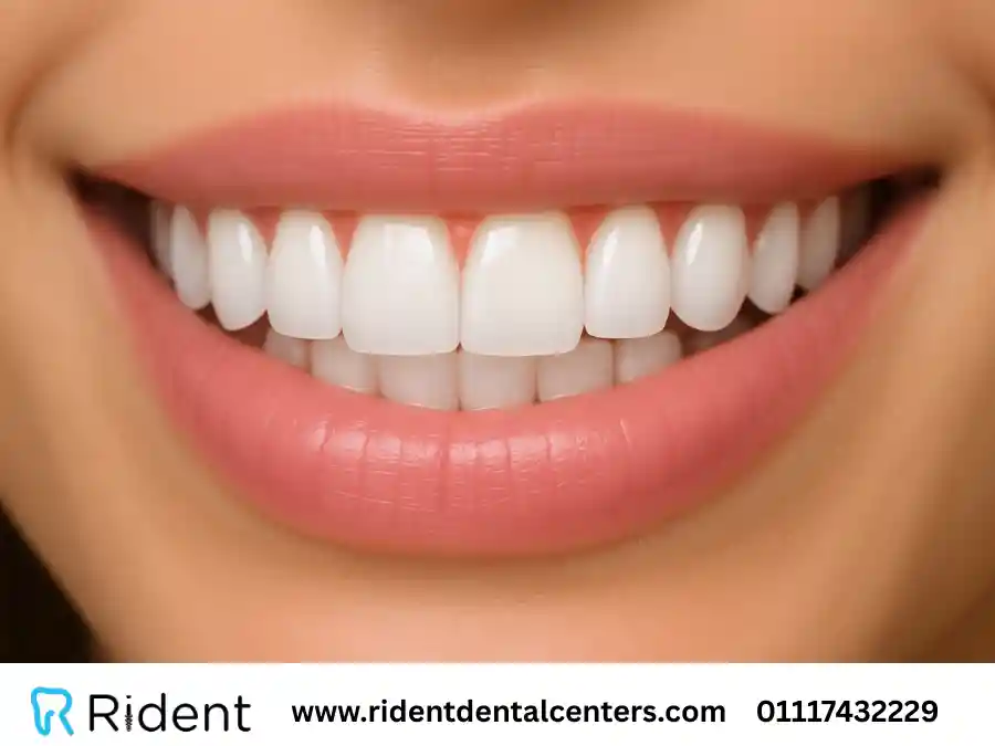 Discover the Features and Types of the Hollywood Smile